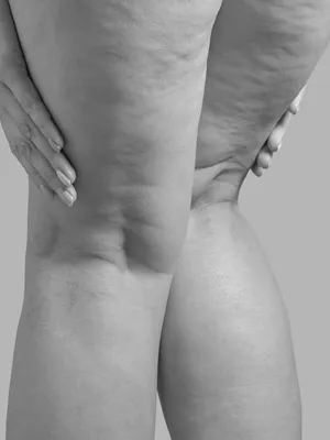 Lipedema em campo grande, mato grosso do sul